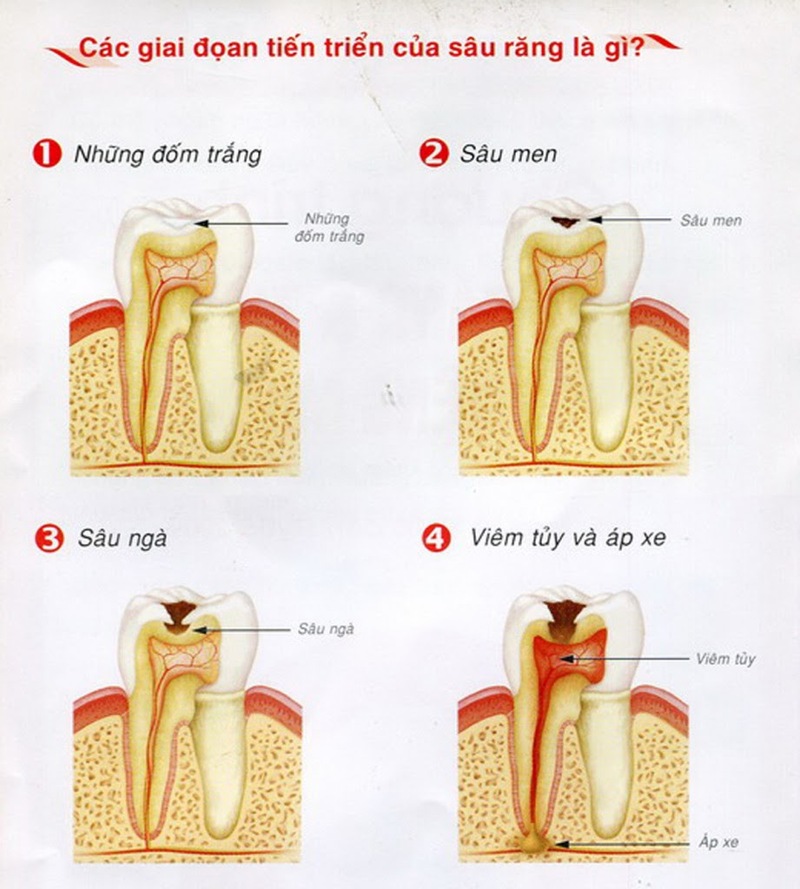 Các giai đoạn phát triển của bênh sâu răng (ảnh st internet)